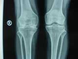 Knee Erosion Knee Erosion