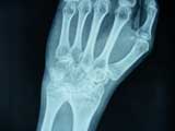 Osteopenia Wrist Osteopenia Wrist