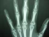 Rheum Arhritis Erosions Rheum Arhritis Erosions