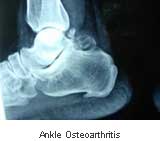 Ankle Osteoarthritis