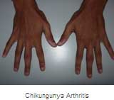 Chikungunya Arthritis