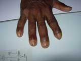 Hand Osteoarthritis