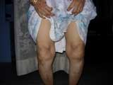 Knee Osteoarthritis