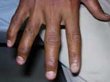 Nail Psoriasis