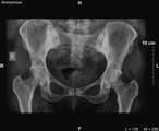 Osteitis Condensans Ilii XRay