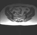 Osteitis Condensans Ilii MRI