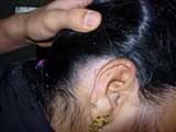 Psoriasis behind Ear