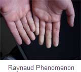 Raynaud Phenomenon