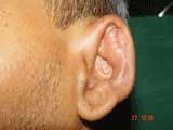 Relapsing Polychondritis 1