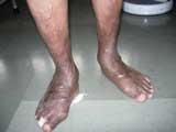 Rheumatoid Foot